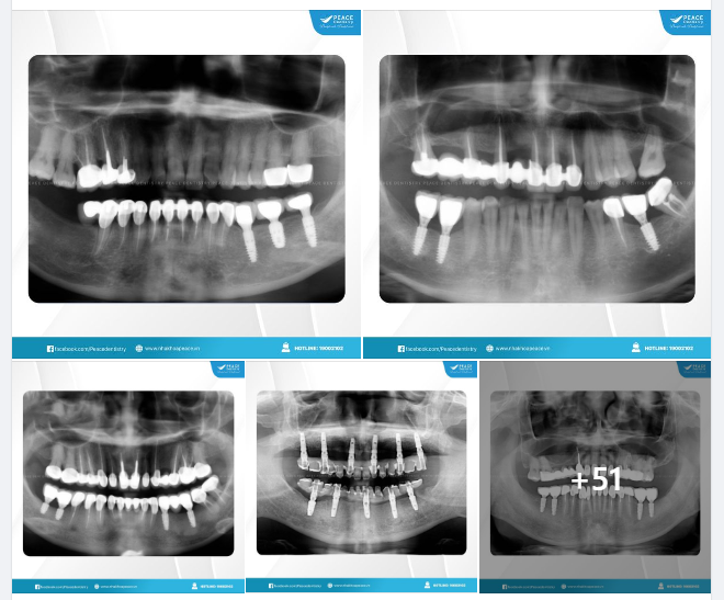 IMPLANT GALLERY - PEACE DENTISTRY (2024 | Part 1)