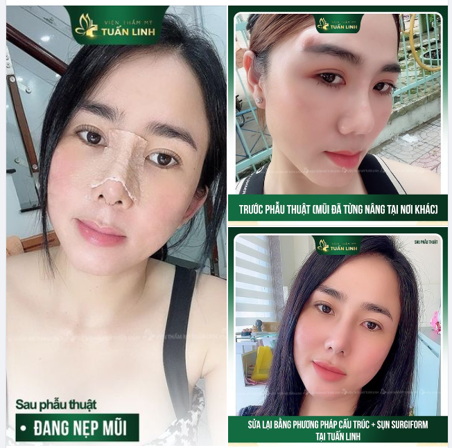 Chọn đúng địa chỉ nâng mũi quan trọng như thế nào?