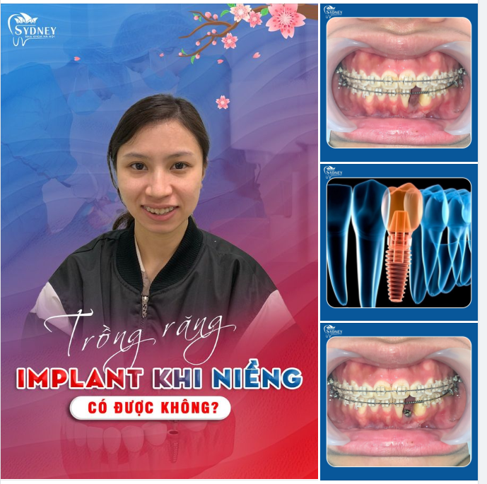 TRỒNG RĂNG IMPLANT TRONG KHI NIỀNG CÓ ĐƯỢC KHÔNG?