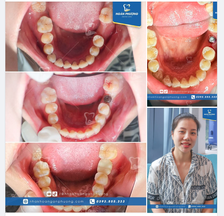 Từ A - Z quy trình 6 tháng phục hình implant cho chị Kim Dung