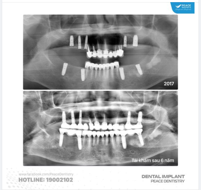 TÁI KHÁM IMPLANT SAU HƠN 6 NĂM ĂN NHAI THOẢI MÁI:
