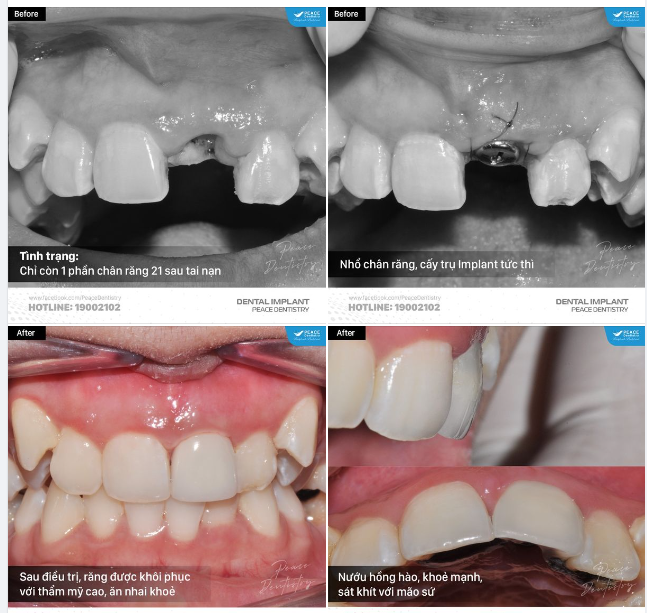 IMPLANT CHO NGƯỜI TRẺ TUỔI VÀ MỘT SỐ LƯU Ý TỪ PEACE DENTISTRY