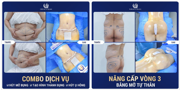 Một ngày rực rỡ của Thẩm mỹ Vũ Quang kết thúc với combo Hút mỡ bụng + Tạo hình thành bụng + Cấy mỡ vòng 3.