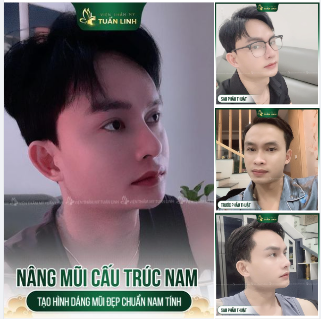 NÂNG MŨI NAM - ĐẸP CHUẨN DÁNG - AN TOÀN - BỀN CHẮC!!