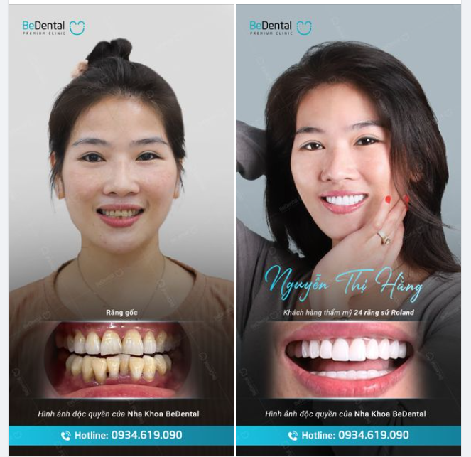 TẠM BIỆT CƯỜI MỈM, KHOE TRỌN RĂNG XINH VỚI DÒNG SỨ ROLAND