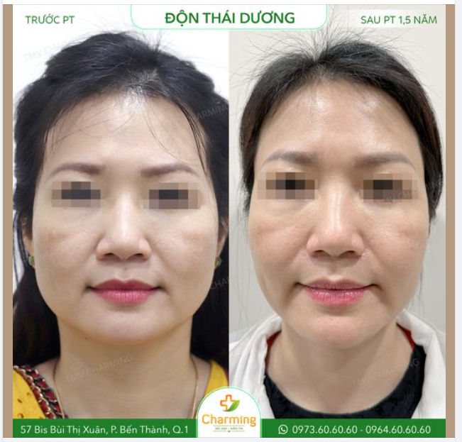 Thái dương hóp cũng là một trong những vấn đề "khó ưa" của nhiều chị em. Nhưng có làm sao, vì giờ chúng ta có thể độn thái dương để giải quyết phần thái dương bị lõm khiến gương mặt hốc hác rồi.