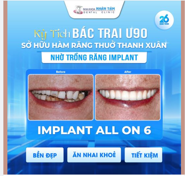 Kỳ tích: Bác trai U90 sở hữu hàm răng thuở thanh xuân nhờ trồng răng Implant