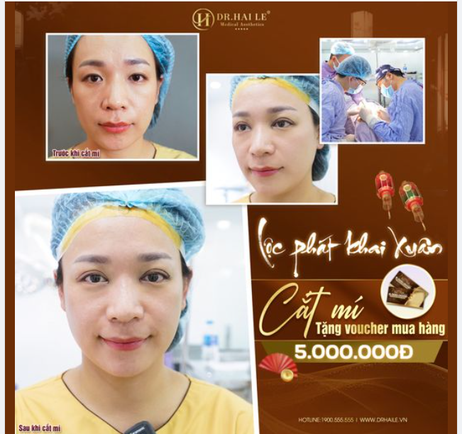 Lộc phát khai xuân Cắt mí tặng voucher mua hàng 5tr