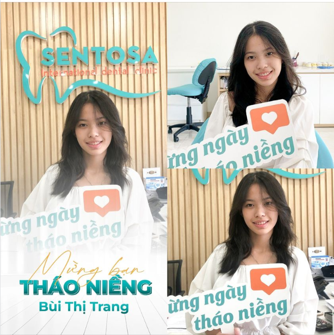 Chúc mừng bạn Trang đã tạm biệt hội đồng niềng hơn 2 năm mang mắc cài.
