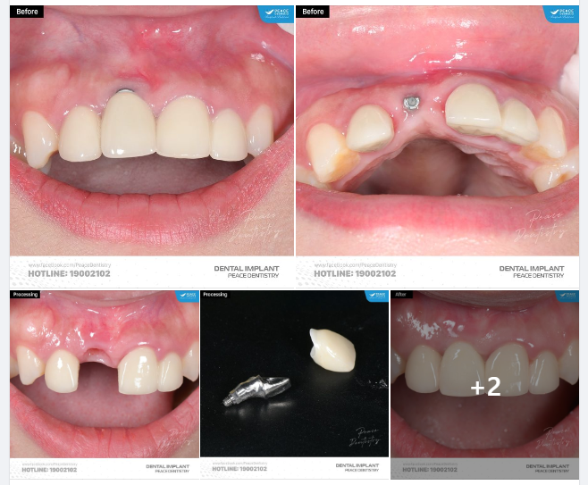 SỬA CHỮA MỘT CA IMPLANT LỖI ĐẾN TỪ NHA KHOA KHÁC