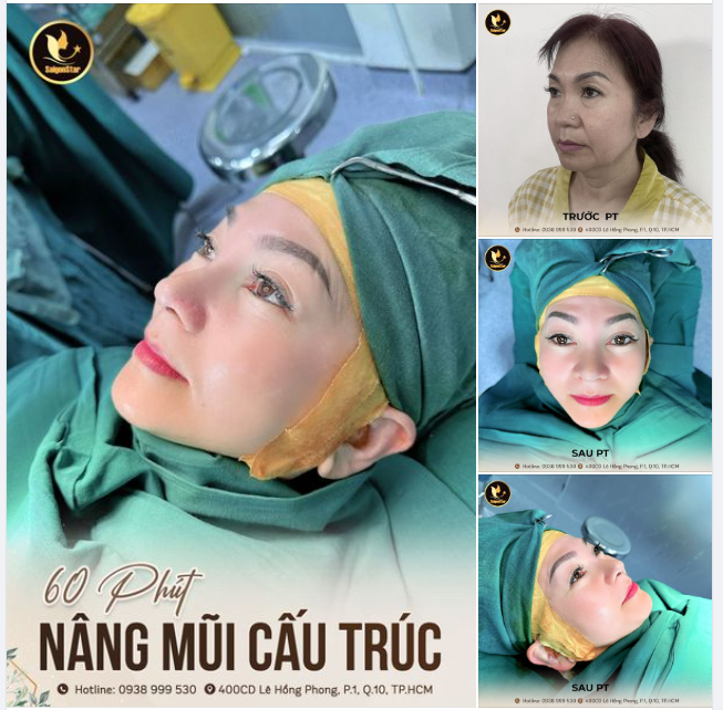 60 PHÚT NÂNG MŨI CẤU TRÚC
