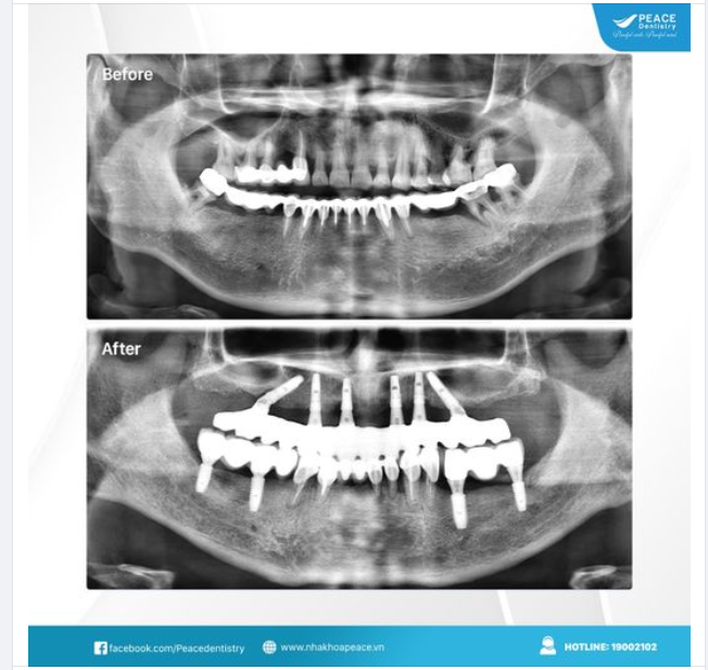 THAY THẾ CẦU RĂNG SỨ BẰNG IMPLANT