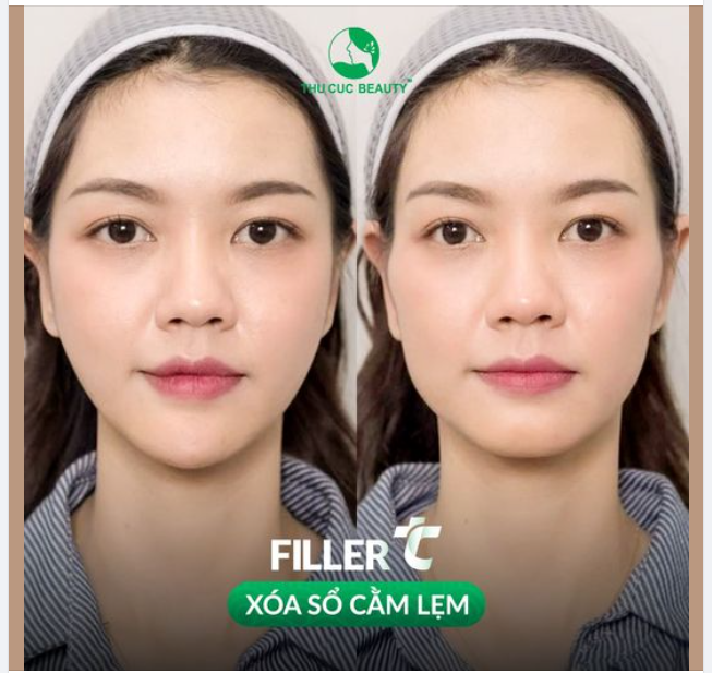Filler TC -46% tặng VÀNG 9999 Khai sắc Rinh Vàng