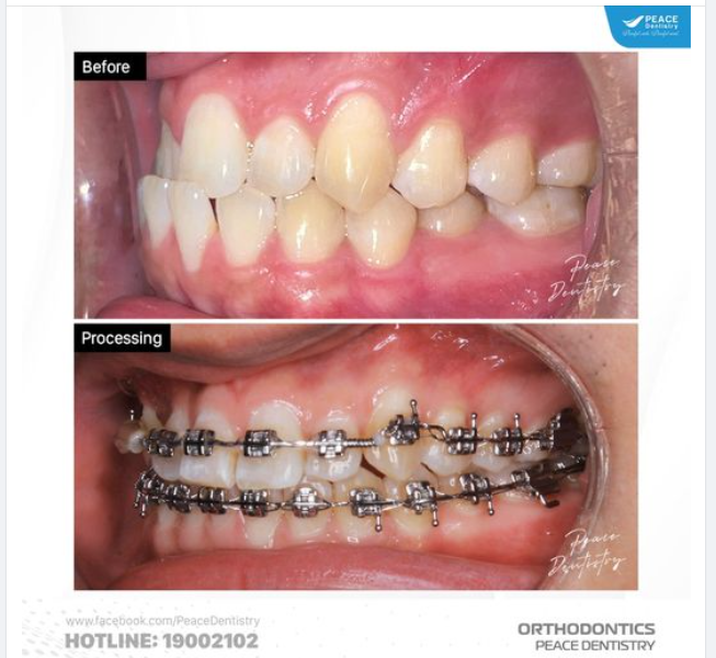 SAU 15 THÁNG VỚI CA LÂM SÀNG CHỈNH NHA PHỨC TẠP: Răng chen chúc, cắn ngược vùng răng cửa và thiếu răng R13.