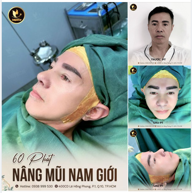 60 PHÚT NÂNG MŨI NAM GIỚI DÁNG MŨI SANG – SÁNG THẦN THÁI