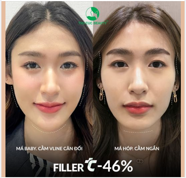 Đẹp đón Tết -46% Filler TC duy nhất 10 suất hôm nay