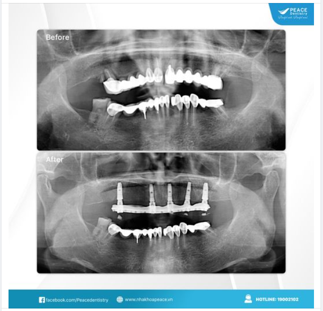 ALL-ON-5 IMPLANT THAY THẾ HOÀN HẢO CHO CẦU RĂNG SỨ DÀI, XUỐNG CẤP