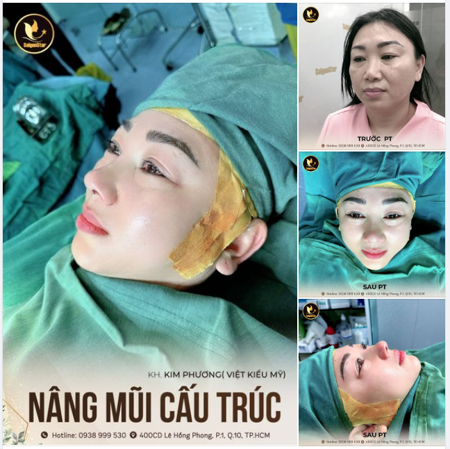 NÂNG MŨI SỬA LẠI – TÁI SINH NHAN SẮC