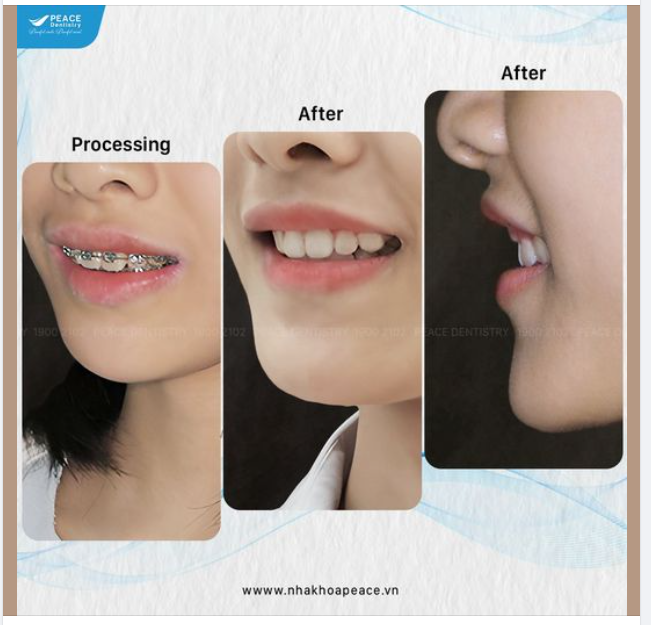 KẾT QUẢ BẠN NHẬN ĐƯỢC SAU KHI NIỀNG RĂNG LÀ GÌ?