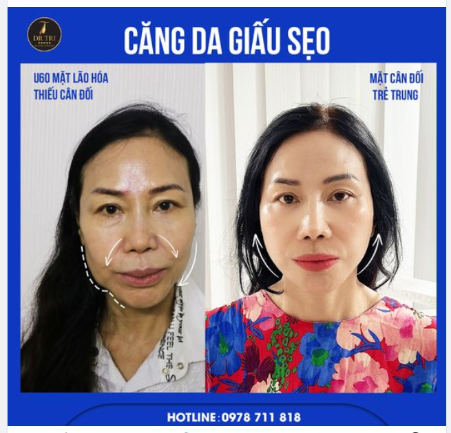 U60 THOÁT LÃO HÓA ĐÓN TẾT