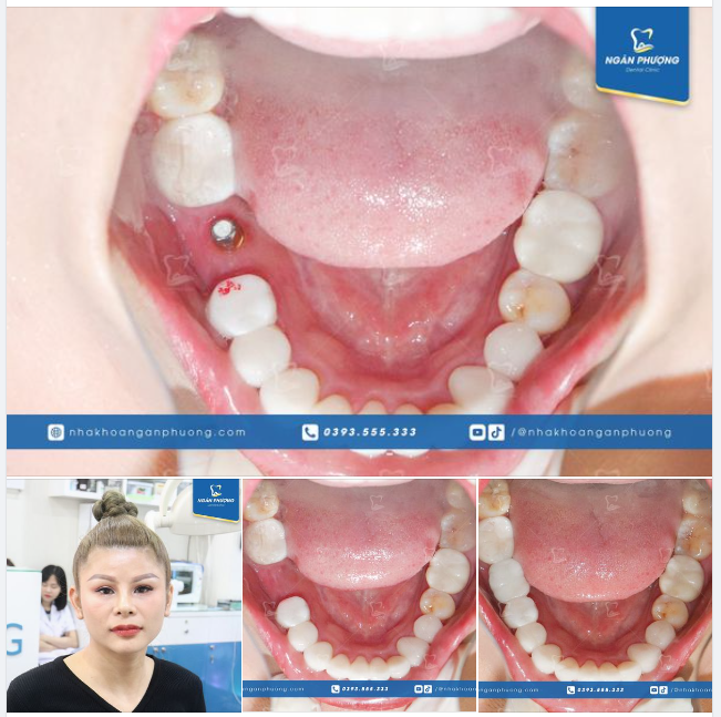 Lắp răng xong cắn táo cứng cái rộp mà vẫn ngon lành. Đầu năm, bác sĩ đã hoàn thành ca phục hình cho chị Vũ Hà rồi: