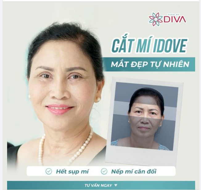 TẠM BIỆT MÍ SỤP, MẮT MỘT MÍ SAU CẮT MÍ MẮT