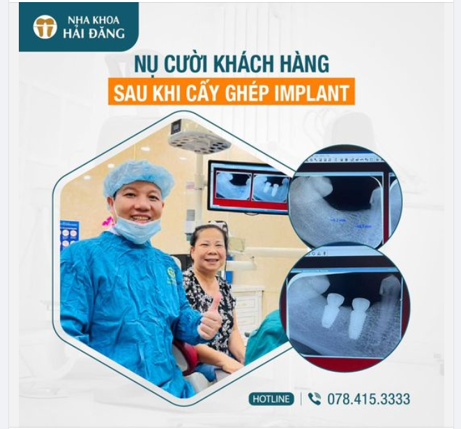 NGẮM NHÌN NỤ CƯỜI KHÁCH HÀNG SAU KHI CẤY GHÉP IMPLANT