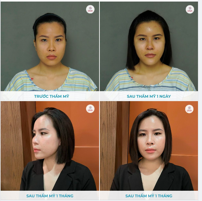 MẶT CÂN ĐỐI, MỀM MẠI TỰ NHIÊN SAU THẨM MỸ