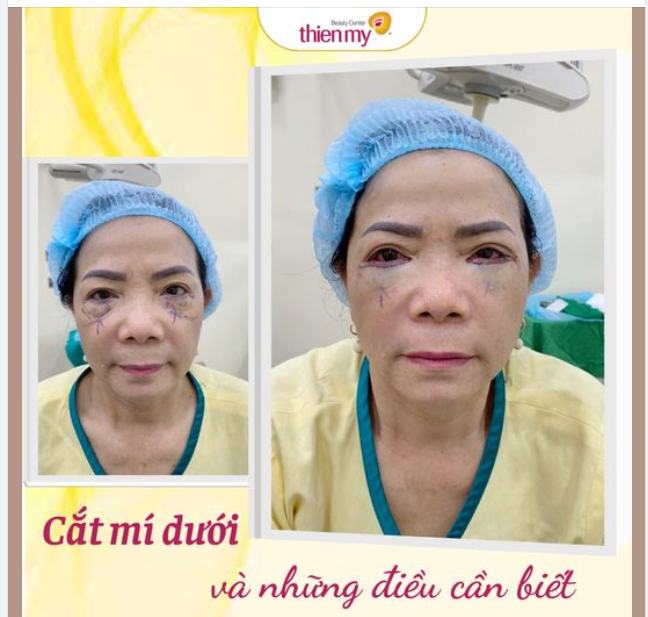 CẮT MÍ DƯỚI là là công nghệ giúp loại bỏ da, mỡ thừa ở mí dưới của mắt. Giải pháp này giúp lấy đi những bọng mắt để trả lại vẻ tươi trẻ, to tròn, long lanh cho đôi mắt.