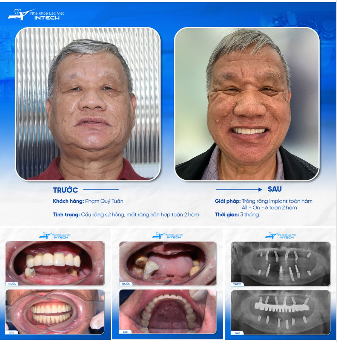 TRỒNG RĂNG IMPLANT TOÀN HÀM - HIỆU QUẢ NHANH HƠN NHỜ CÔNG NGHỆ DCT TẠI LẠC VIỆT INTECH