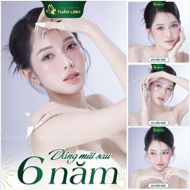DÁNG MŨI SAU 6 NĂM NÂNG TẠI TUẤN LINH!!