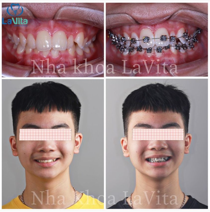 NHỮNG ĐIỀU CẦN LƯU Ý SAU KHI GẮN MẮC CÀI CHỈNH NHA