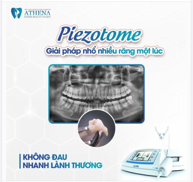 NHỔ NHIỀU RĂNG KHÔN NHƯNG KHÔNG ĐAU !? CỰC ĐƠN GIẢN VỚI MÁY PIEZOTOME TẠI NHA KHOA ATHENA