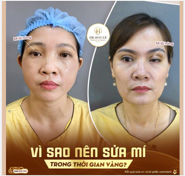 Vì sao nên sửa mí trong thời gian vàng?