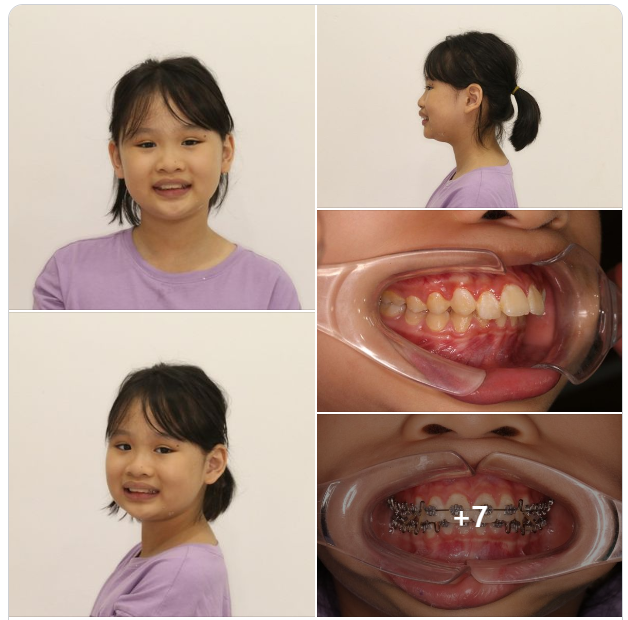 NIỀNG RĂNG SỚM CHO CON, CHA MẸ YÊN TÂM VỀ NỤ CƯỜI CON SAU NÀY