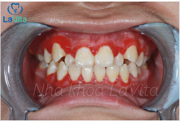 Viêm lợi là tình trạng xảy ra do mảng bám có chứa vi khuẩn tích tụ trên răng, gây viêm mô lợi.