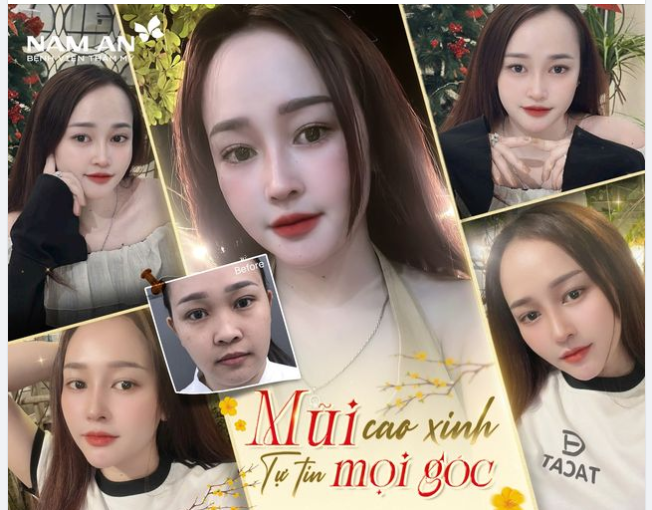 MŨI CAO XINH TỰ TIN MỌI GÓC