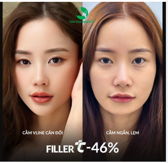 Khắc phục cằm lẹm, không cân đối