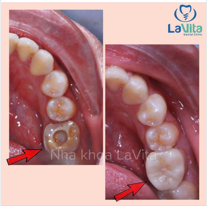 Tuy nhiên, đó không phải là giải pháp duy nhất cho tình trạng của bạn, mà Inlay, Onlay cũng hoàn toàn có thể đáp ứng được một cách hoàn hảo.
