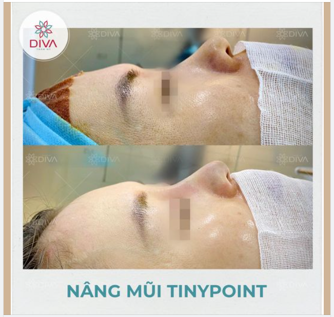 MŨI CAO HÀI HÒA, TỰ NHIÊN SAU NÂNG MŨI TINY POINT