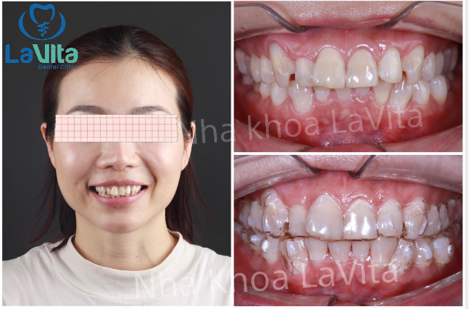 NHỮNG ƯU ĐIỂM VƯỢT TRỘI CỦA CHỈNH NHA BẰNG KHAY TRONG SUỐT SO VỚI CHỈNH NHA BẰNG MẮC CÀI