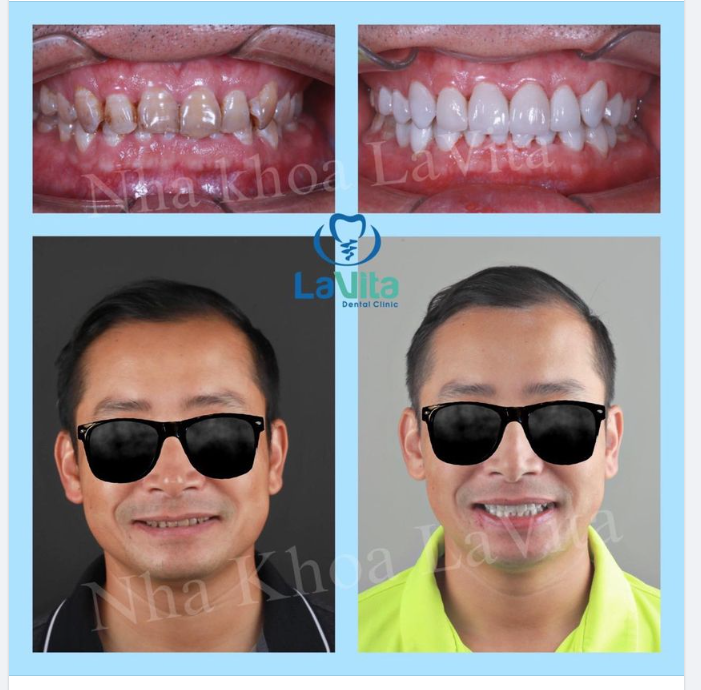 Răng sứ nhưng phải tự nhiên, y như răng thật, vậy mới tạo nên một ca thẩm mỹ thành công!