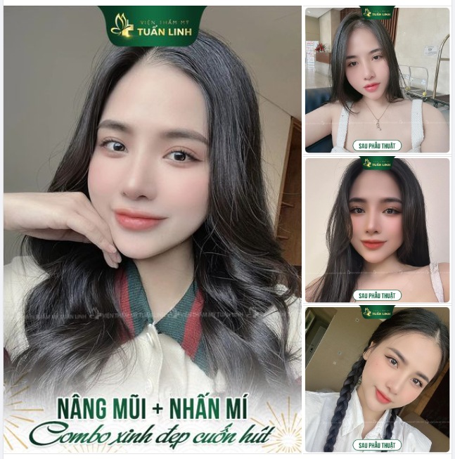 Hình ảnh “siêu thực” của khách hàng sau Nâng mũi + Nhấn mí tại Tuấn Linh!!!