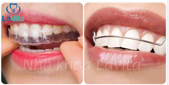 TẠI SAO PHẢI ĐEO HÀM DUY TRÌ SAU KHI KẾT THÚC QUÁ TRÌNH CHỈNH NHA?