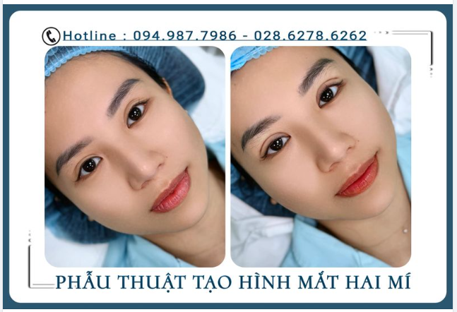 Khách hàng đến với tình trạng mắt nhấn bị lỗi tại spa, cùng xem KAT cải thiện lại đôi mắt thế nào nhé