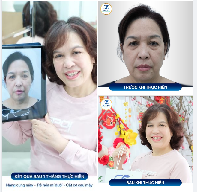 Cô Huyền là cán bộ đã về hưu được 6 năm. Cô chia sẻ trước đây do áp lực công việc nên vùng cơ cau mày của cô bị hằn sâu, bọng mắt to dày, mí cụp buồn khiến gương mặt cô già nua.