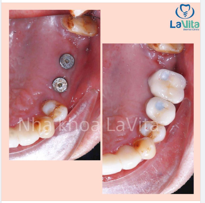 TẠI SAO CẤY GHÉP IMPLANT ĐANG ĐƯỢC RẤT NHIỀU KHÁCH HÀNG LỰA CHỌN ĐỂ THAY THẾ RĂNG ĐÃ MẤT?