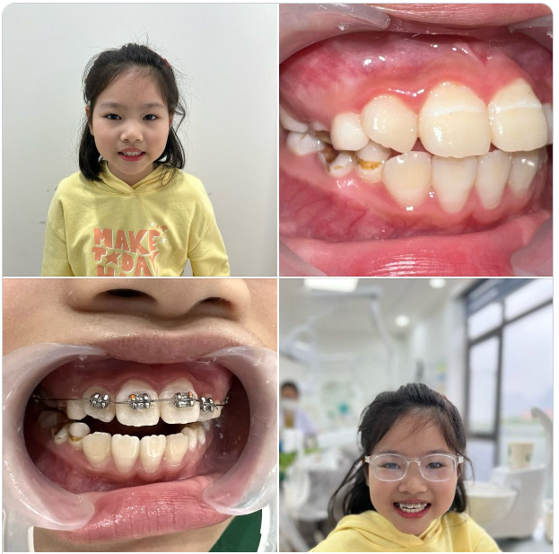TIỀN CHỈNH NHA: RĂNG BÉ ĐẸP - MẸ YÊN TÂM