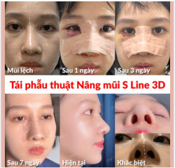 Hành trình TỪNG NGÀY THAY ĐỔI của Việt kiều Hàn Quốc NÂNG MŨI S LINE 3D hồi sinh MŨI VẸO LỆCH