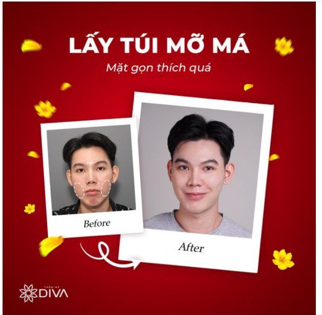 TÁCH MỠ MÁ TRONG – MẶT GỌN, THANH THOÁT SAU 15 PHÚT